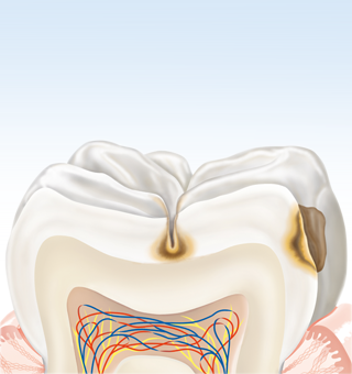 Как се образува зъбният кариес?